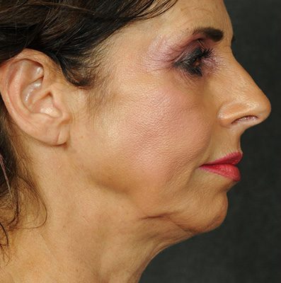 Ponytail Facelift before and after, case 68, view 5 (before)