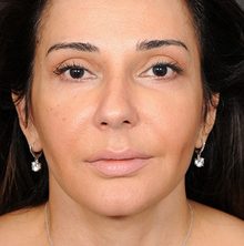 Ponytail Facelift before and after, case 69 (after)