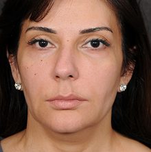 Ponytail Facelift before and after, case 69 (before)