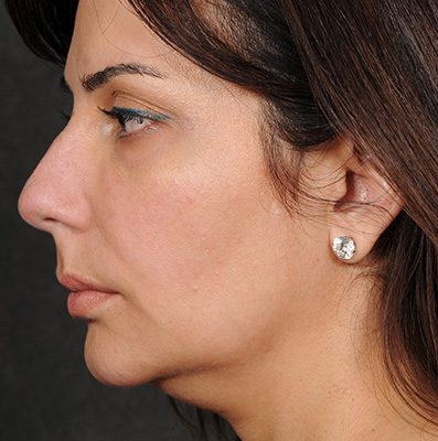 Ponytail Facelift before and after, case 69, view 3 (before)