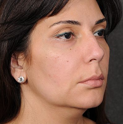Ponytail Facelift before and after, case 69, view 4 (before)
