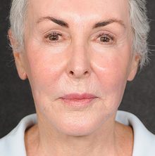 Ponytail Facelift before and after, case 70 (after)