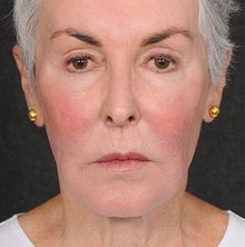 Ponytail Facelift before and after, case 70 (before)