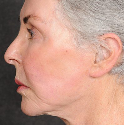 Ponytail Facelift before and after, case 70, view 3 (after)