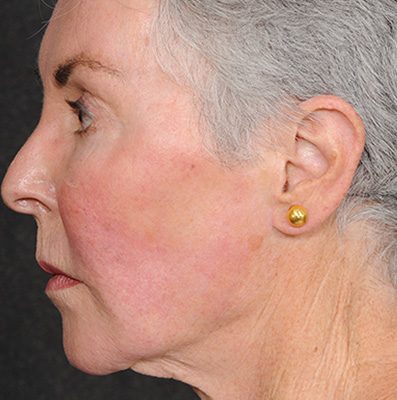 Ponytail Facelift before and after, case 70, view 3 (before)