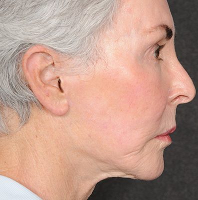 Ponytail Facelift before and after, case 70, view 4 (after)