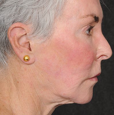Ponytail Facelift before and after, case 70, view 4 (before)
