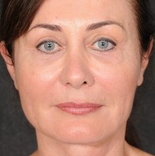 Ponytail Facelift before and after, case 71 (after)