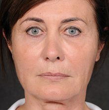 Ponytail Facelift before and after, case 71 (before)