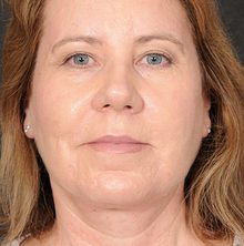 Ponytail Facelift before and after, case 72 (after)