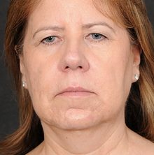 Ponytail Facelift before and after, case 72 (before)