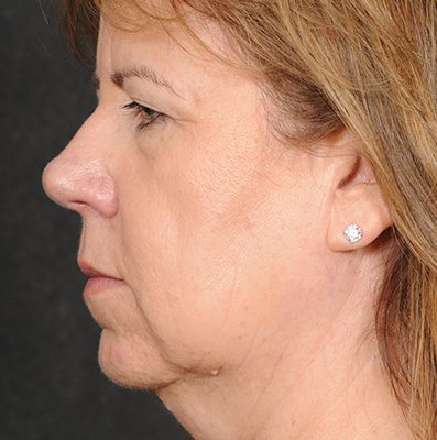 Ponytail Facelift before and after, case 72, view 3 (before)