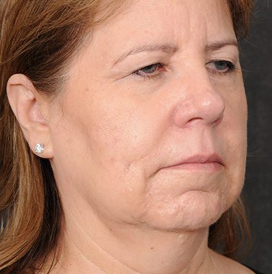 Ponytail Facelift before and after, case 72, view 4 (before)