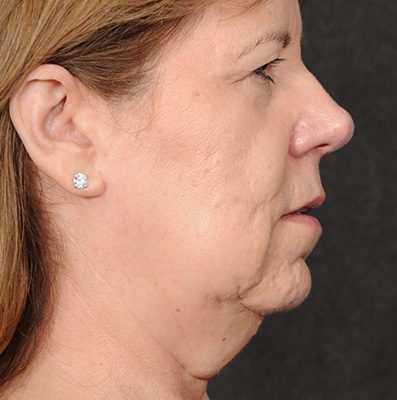 Ponytail Facelift before and after, case 72, view 5 (before)