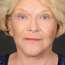 Ponytail Facelift before and after, case 73 (after)