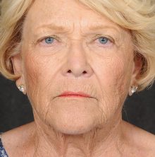Ponytail Facelift before and after, case 73 (before)