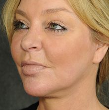 Ponytail Facelift before and after, case 74 (after)