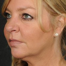 Ponytail Facelift before and after, case 74 (before)