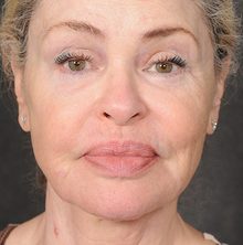 Ponytail Facelift before and after, case 75 (after)