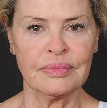 Ponytail Facelift before and after, case 75 (before)