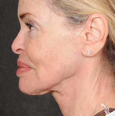 Ponytail Facelift before and after, case 75, view 3 (after)