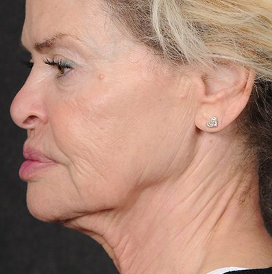 Ponytail Facelift before and after, case 75, view 3 (before)