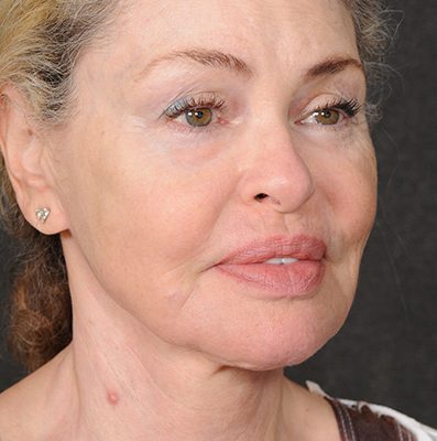 Ponytail Facelift before and after, case 75, view 4 (after)