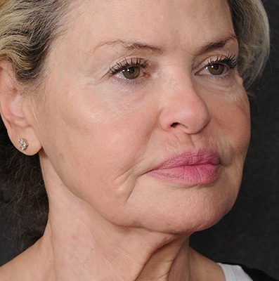 Ponytail Facelift before and after, case 75, view 4 (before)