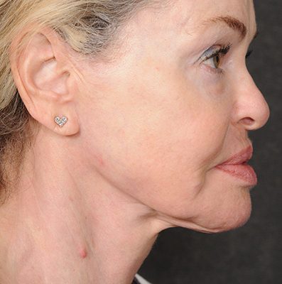 Ponytail Facelift before and after, case 75, view 5 (after)