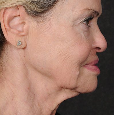Ponytail Facelift before and after, case 75, view 5 (before)