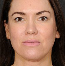 Ponytail Facelift before and after, case 76 (after)