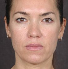 Ponytail Facelift before and after, case 76 (before)