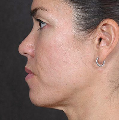 Ponytail Facelift before and after, case 76, view 3 (before)
