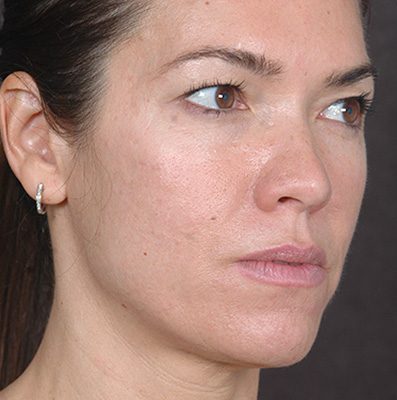 Ponytail Facelift before and after, case 76, view 4 (before)