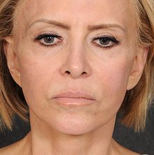 Ponytail Facelift before and after, case 77 (before)