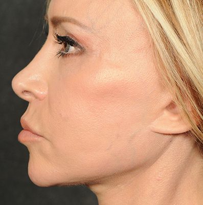 Ponytail Facelift before and after, case 77, view 3 (after)