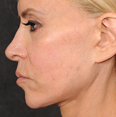 Ponytail Facelift before and after, case 77, view 3 (before)