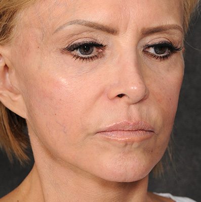 Ponytail Facelift before and after, case 77, view 4 (before)
