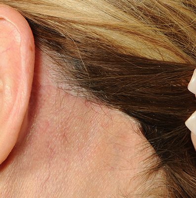 Ponytail Facelift before and after, case 77, view 5 (after)