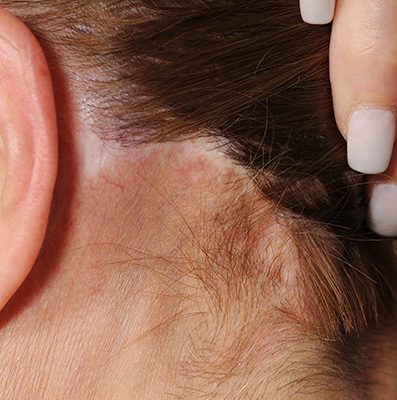 Ponytail Facelift before and after, case 77, view 5 (before)