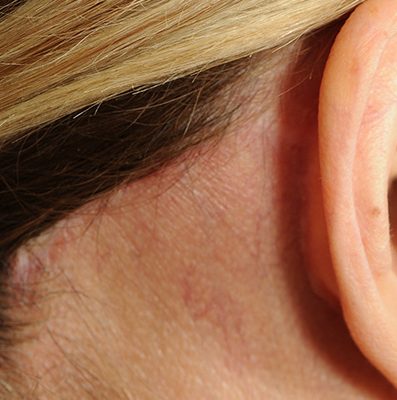 Ponytail Facelift before and after, case 77, view 6 (after)