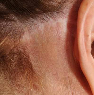 Ponytail Facelift before and after, case 77, view 6 (before)