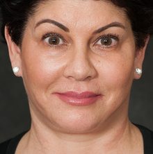 Ponytail Facelift before and after, case 79 (after)