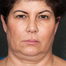 Ponytail Facelift before and after, case 79 (before)