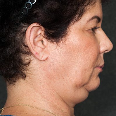 Ponytail Facelift before and after, case 79, view 3 (before)