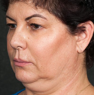 Ponytail Facelift before and after, case 79, view 4 (before)