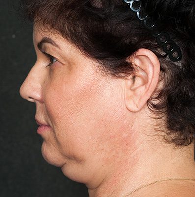 Ponytail Facelift before and after, case 79, view 5 (before)