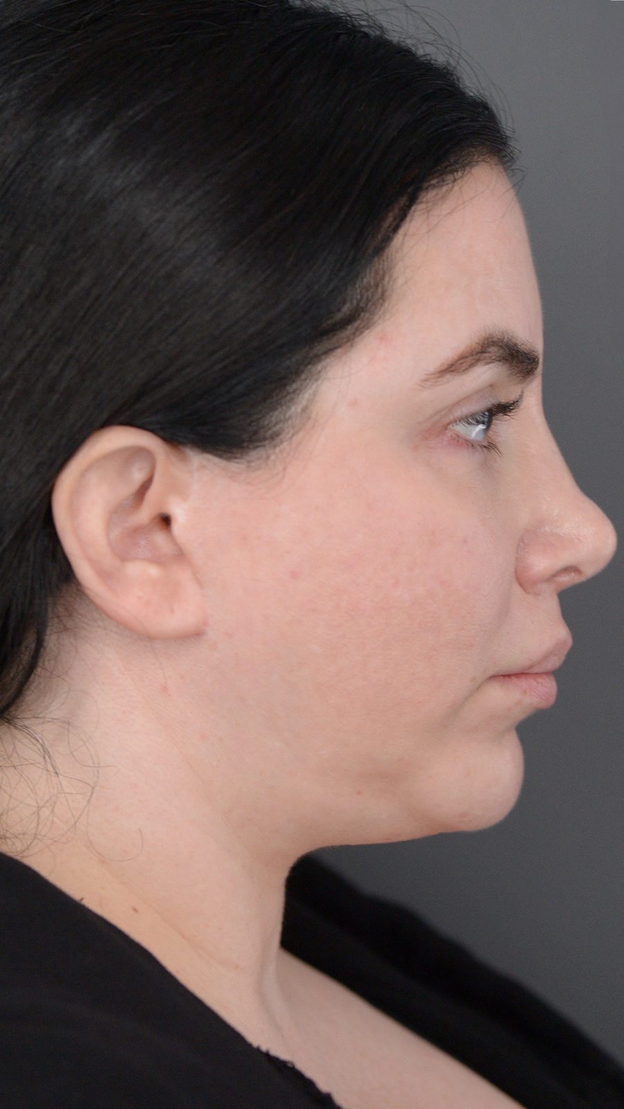 Ponytail Lift before and after, case 01, view 3 (before)