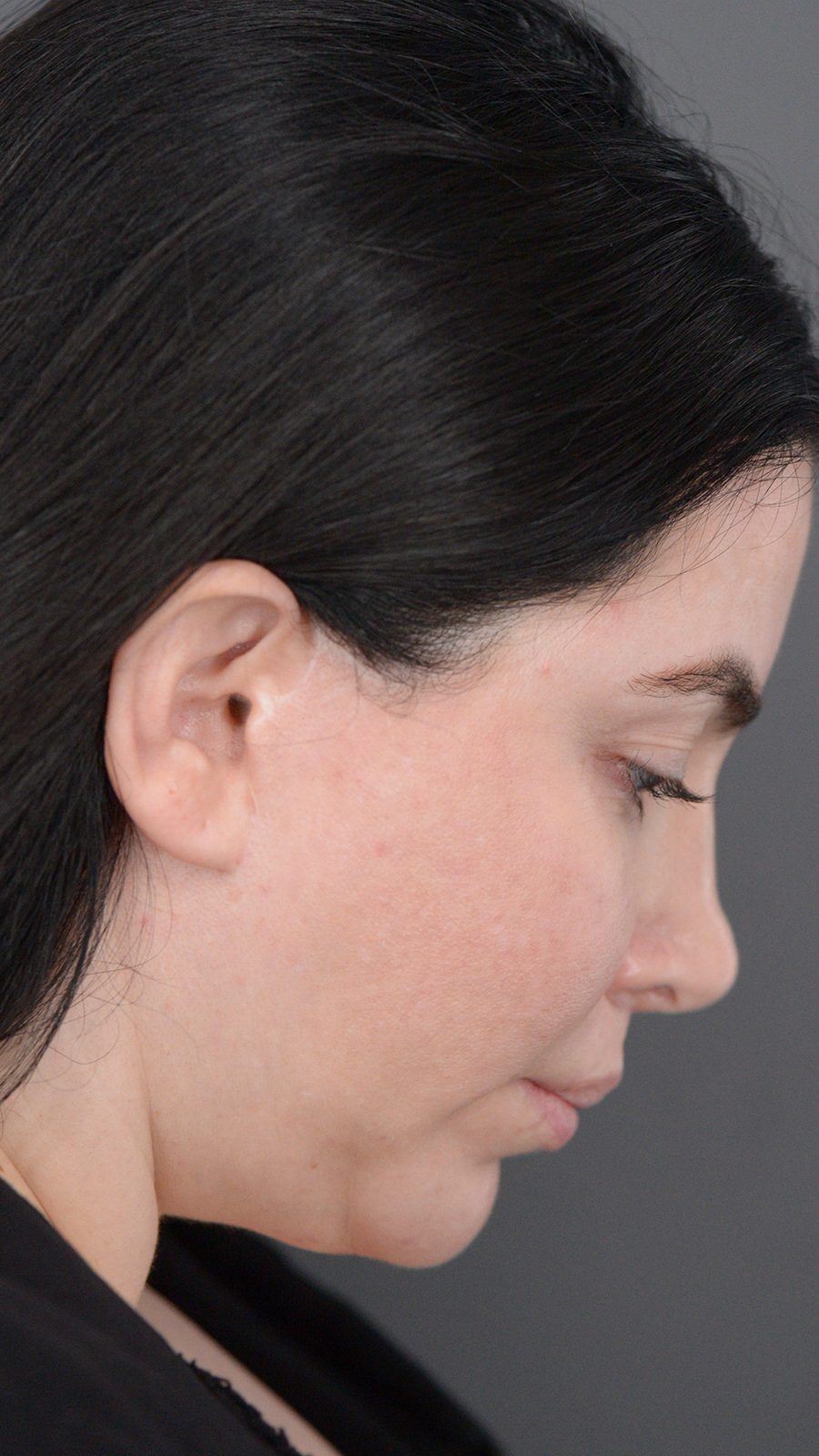Ponytail Lift before and after, case 01, view 4 (before)