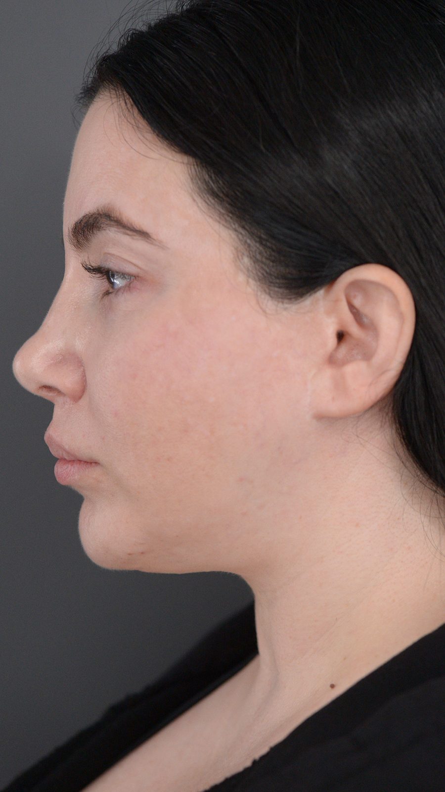 Ponytail Lift before and after, case 01, view 6 (before)